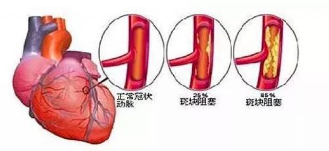 你的心臟在求救！急性心梗的這些預(yù)警信號(hào)， 你知道嗎？(圖2)