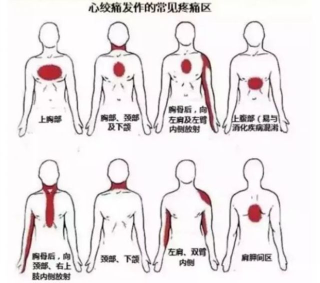 你的心臟在求救！急性心梗的這些預(yù)警信號(hào)， 你知道嗎？(圖8)