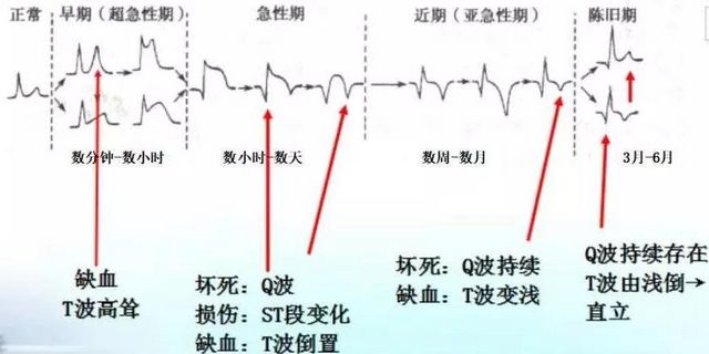 你的心臟在求救！急性心梗的這些預(yù)警信號(hào)， 你知道嗎？(圖9)