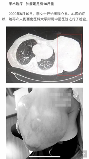 【圍觀】腫瘤這么大，一定是惡性了？