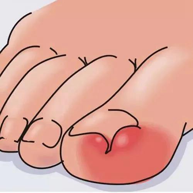 【擴散】腳指甲剪太短！代價可不只是痛……(圖2)