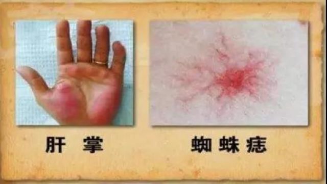 【關(guān)注】吳孟達(dá)患肝癌去世！這些信號(hào)要警惕？(圖8)