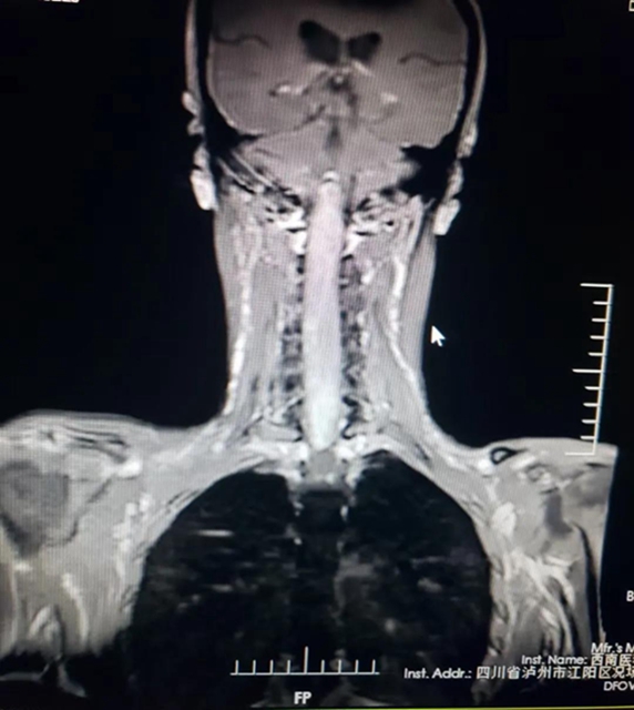 30厘米罕見腫瘤 ，10名醫(yī)療人員，連續(xù)11個小時的手術(shù)······(圖1)