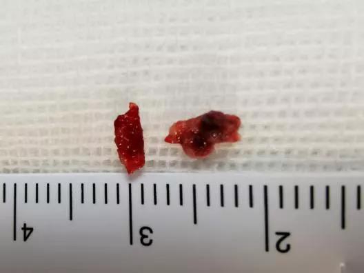 七旬婆婆突發(fā)腦梗死，深夜搶救1小時完全恢復(fù)！(圖4)