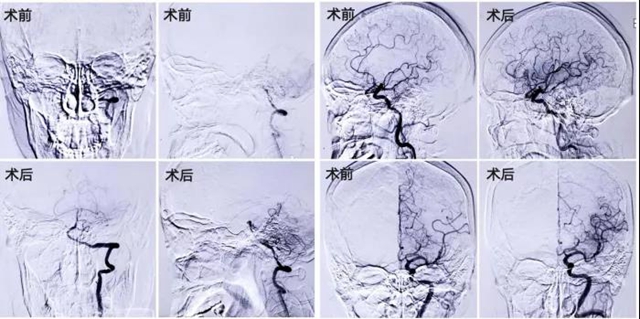 七旬婆婆突發(fā)腦梗死，深夜搶救1小時完全恢復(fù)！(圖5)