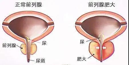 【擴散】男性專屬，一旦發(fā)現(xiàn)，大部分已是晚期？(圖2)