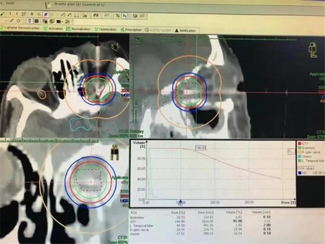 腫瘤難治？你還不知道西南醫(yī)大附竟有這項對付眾多腫瘤的領先技術！(圖15)