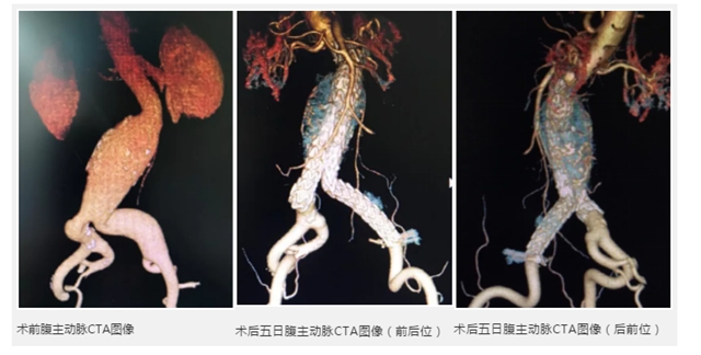 瀘州市人民醫(yī)院獨立成功完成首例腹主動脈瘤血管腔內(nèi)修復(fù)術(shù)(圖5)