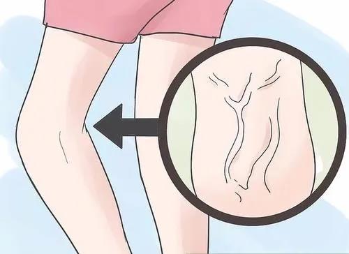 【圍觀】瀘州女教師小腿酸痛1個(gè)月，一雙美腿險(xiǎn)些毀掉(圖2)