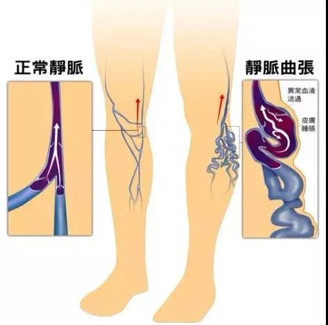 【圍觀】瀘州女教師小腿酸痛1個(gè)月，一雙美腿險(xiǎn)些毀掉(圖5)