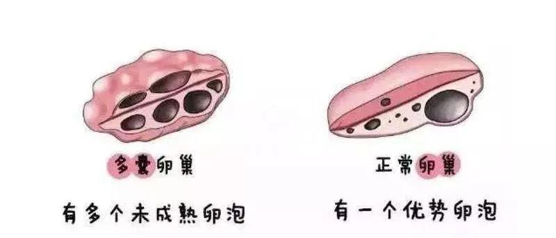 【提醒】女性多毛、月經(jīng)紊亂、痤瘡，當心得了這個?。?圖4)