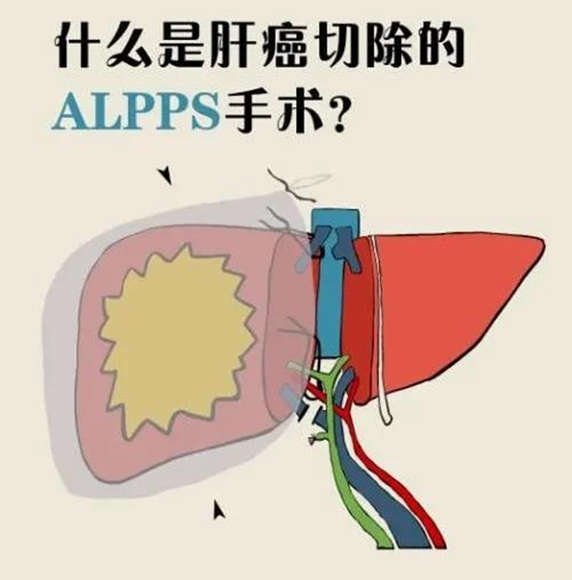 【擴(kuò)散】肝癌中晚期患者，可以根治啦？(圖4)