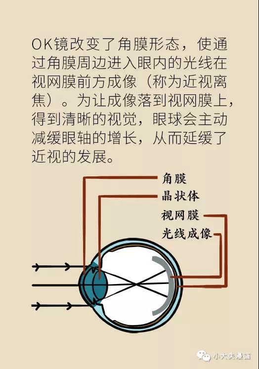 暑假到，配鏡忙，OK鏡真能緩解孩子近視？看專家解答(圖10)