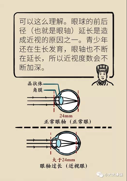 暑假到，配鏡忙，OK鏡真能緩解孩子近視？看專家解答(圖9)