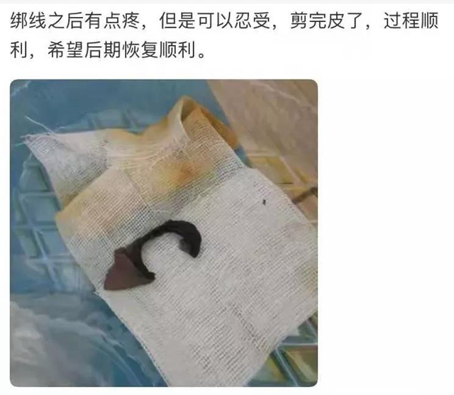 【圍觀】真猛！男子竟自己割包皮？