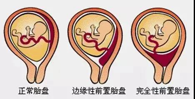 【兇險(xiǎn)】胎盤完全堵住宮口，二胎媽媽差點(diǎn)送命？(圖3)