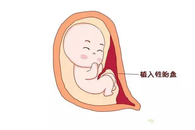 【兇險(xiǎn)】胎盤完全堵住宮口，二胎媽媽差點(diǎn)送命？(圖4)