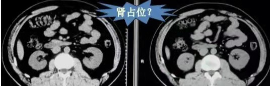 【圍觀】剛做完CT，醫(yī)生又讓做CT增強(qiáng)，有必要嗎？(圖6)
