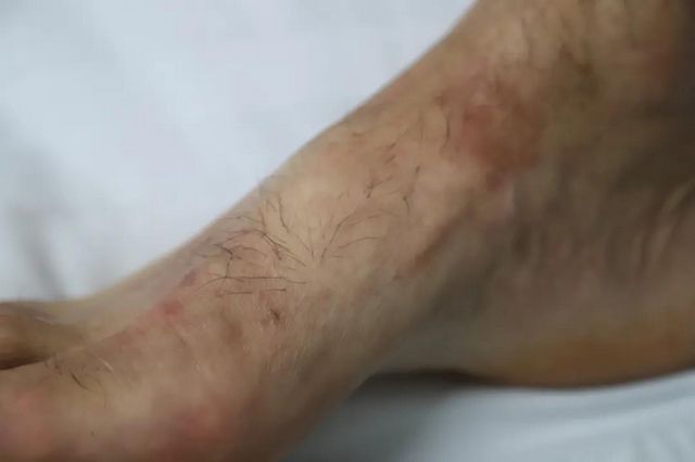 【擴(kuò)散】致命“紅火蟻”出沒，瀘州男子被咬傷入院(圖3)