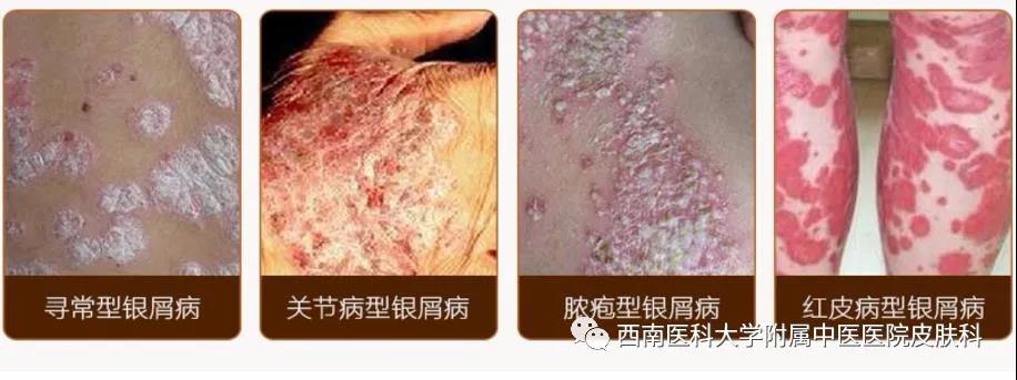 【圍觀】大媽全身瘙癢起紅斑，還脫皮！(圖6)