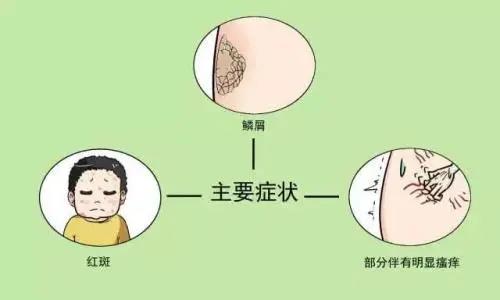 【圍觀】大媽全身瘙癢起紅斑，還脫皮！(圖7)