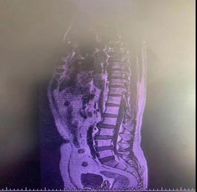 【關(guān)注】男子腰痛，醫(yī)生取出21顆“骨頭渣渣”！(圖3)