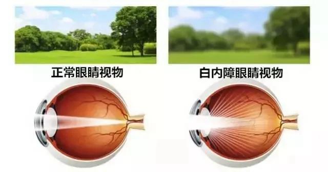 【技術(shù)】小切口大智慧—合江縣中醫(yī)醫(yī)院開展首例白內(nèi)障手術(shù)！(圖7)