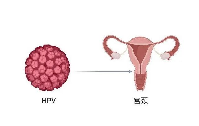 【擴(kuò)散】感染了HPV病毒，就是得了宮頸癌？