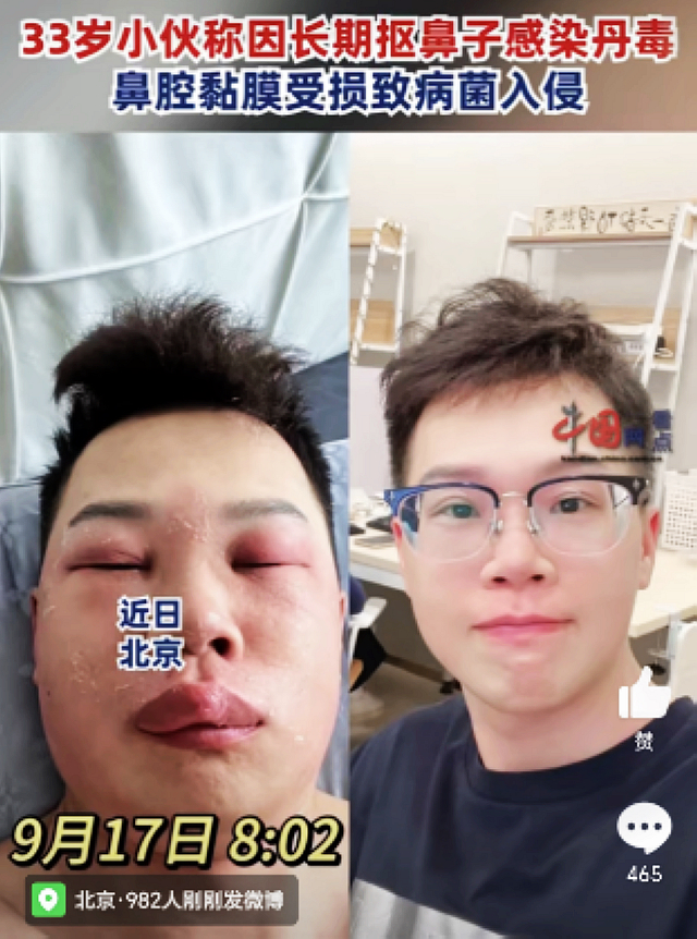 【圍觀】感染丹毒，33歲小伙面目全非!這個(gè)壞習(xí)慣你都有……