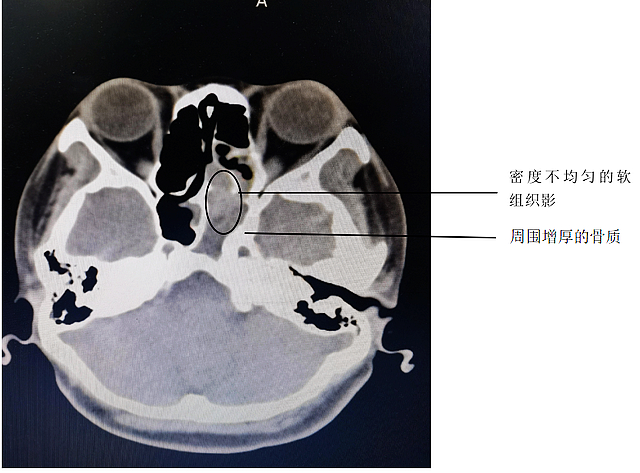 【圍觀】咳到出血，原來是鼻子出問題了